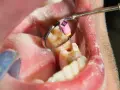 Dentysta wykonuje leczenie kanałowe martwego zęba, używając narzędzi widocznych w lusterku stomatologicznym.