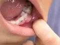 Widoczna opuchlizna od zęba, która powoduje dyskomfort.