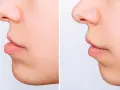 Przed i po: górne zęby wysunięte do przodu, teraz idealnie dopasowane.