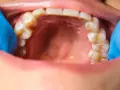 Widoczne zęby i jama ustna, z niebieską rękawiczką dentystyczną. Na dziąśle widoczny jest krwiak.