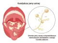Grzybica jamy ustnej po antybiotyku: białe naloty na języku i podniebieniu, powiększenie drożdżaków Candida albicans.