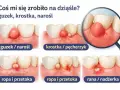 Ilustracja pokazuje zmiany na dziąśle: guzek, krostkę, ropień, z którego może być wyciągana ropa z zęba, aż do rany.