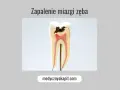 Model zęba z widocznym ubytkiem i zapaleniem miazgi.