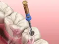 Ząb z ropą wymaga leczenia kanałowego. Dentysta używa narzędzia do oczyszczenia zainfekowanego kanału.