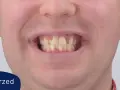 Uśmiech przed leczeniem aparatem Invisalign. Widoczne nierówne i lekko pożółkłe zęby.