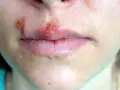 Usta z aftą i opryszczką. Widoczne zaczerwienienie, pęcherzyki i łuszcząca się skóra wokół ust.