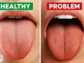 Zdrowy język vs. język z kserostomią. Suchość w ustach (kserostomia co to) objawia się zmianą wyglądu języka.