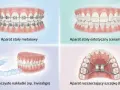 Korekcja zgryzu krzyżowego: aparaty metalowe, estetyczne, nakładki Invisalign i aparat Hyrax do rozszerzania szczęki.