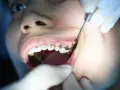 Dziecko z aparatem ortodontycznym, któremu dentysta czyści zęby. Irygator zamiast nici ułatwia higienę.