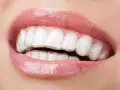 Zbliżenie na usta z błyszczącym błyszczykiem i widocznymi przezroczystymi nakładkami, które korygują zgryz. To dyskretny aparat Invisalign.