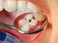 Zęby z próchnicą widziane w lusterku dentystycznym. Ksylitol, naturalny słodzik, może pomóc w zapobieganiu próchnicy.