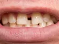 Usta z widocznymi zębami, między którymi jest duża diastema.