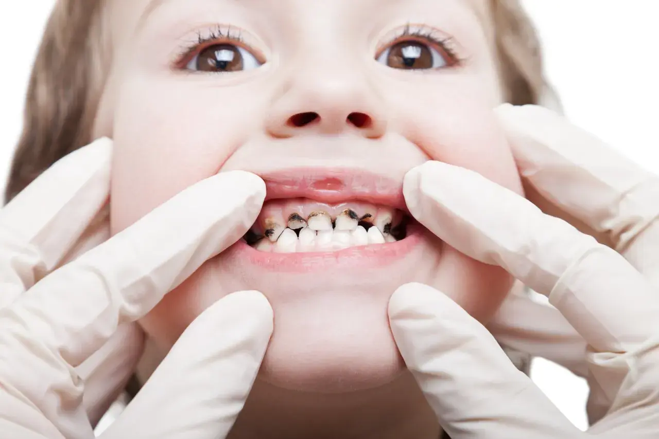 Dziecko z widoczną próchnicą zębów, badane przez dentystę w rękawiczkach.