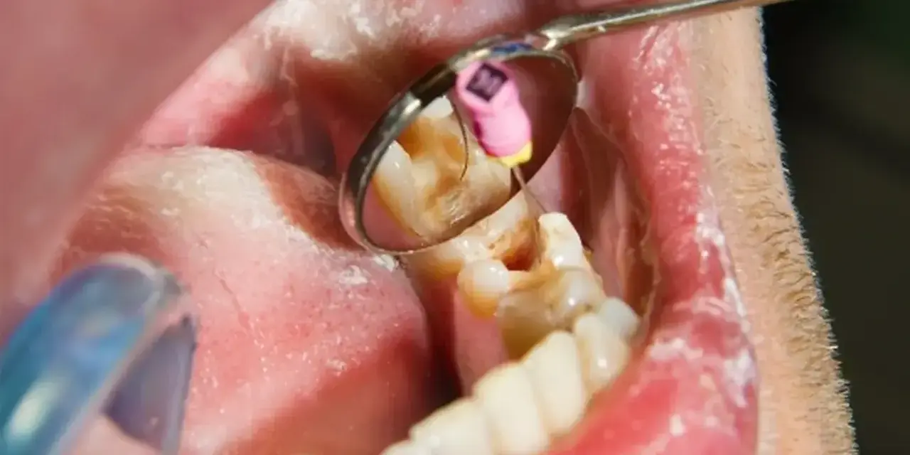 Dentysta wykonuje leczenie kanałowe martwego zęba, używając narzędzi widocznych w lusterku stomatologicznym.