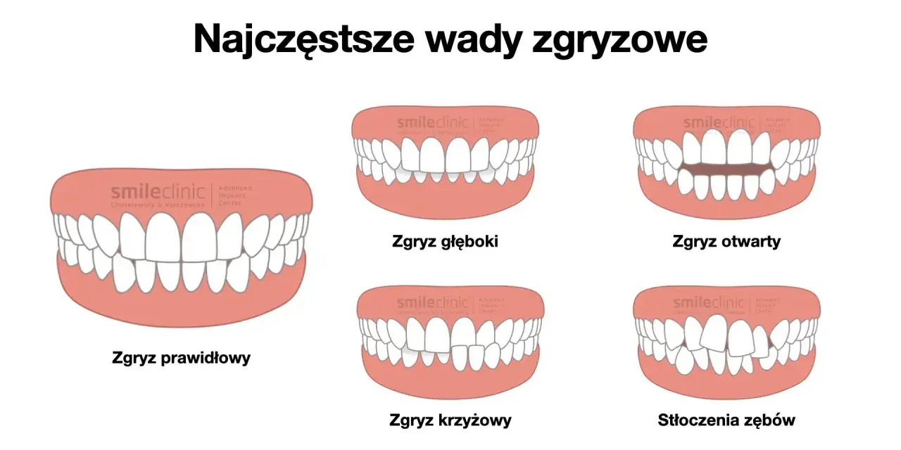 Ilustracja pokazuje różne wady zgryzu: prawidłowy, głęboki, otwarty, krzyżowy i stłoczenia zębów.