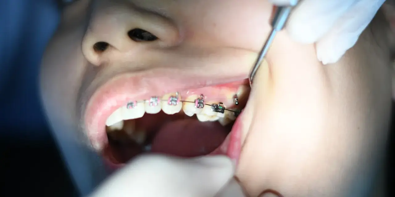 Dziecko z aparatem ortodontycznym, któremu dentysta czyści zęby. Irygator zamiast nici ułatwia higienę.