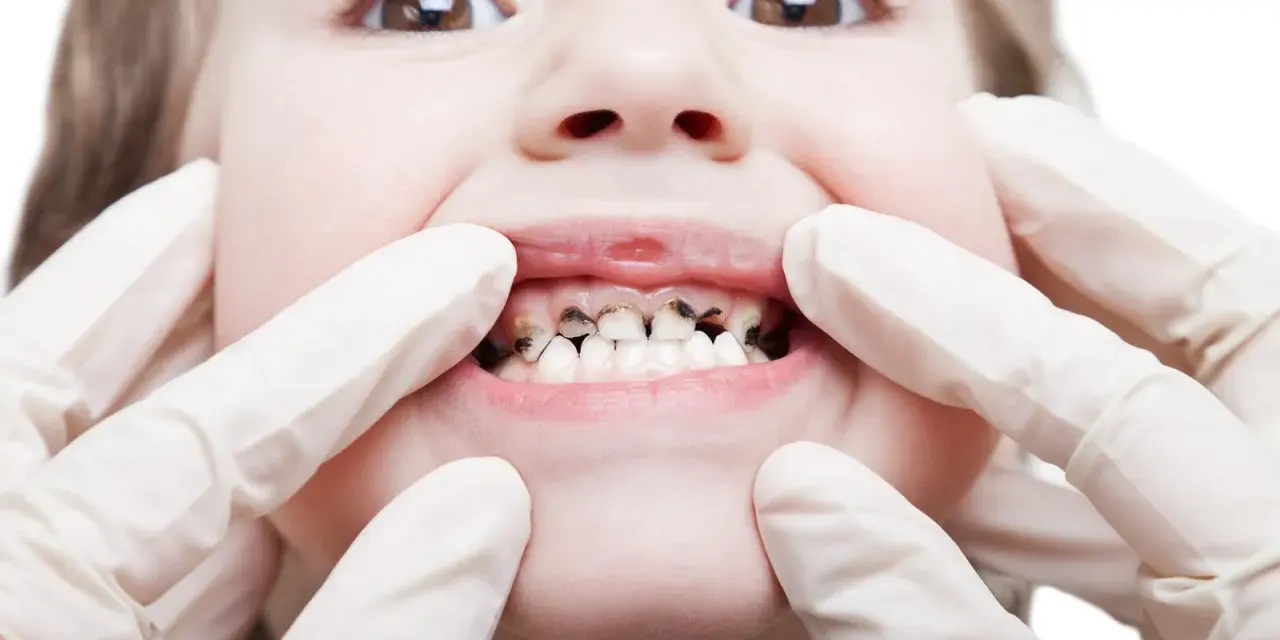 Dziecko z widoczną próchnicą zębów, badane przez dentystę w rękawiczkach.