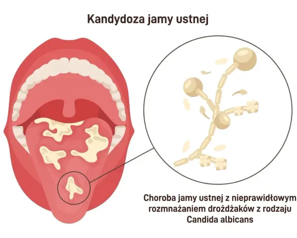 Grzybica jamy ustnej po antybiotyku: białe naloty na języku i podniebieniu, powiększenie drożdżaków Candida albicans.