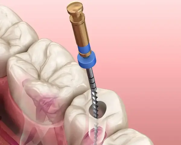 Ząb z ropą wymaga leczenia kanałowego. Dentysta używa narzędzia do oczyszczenia zainfekowanego kanału.