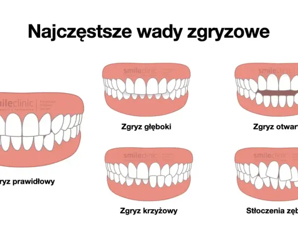 Ilustracja pokazuje różne wady zgryzu: prawidłowy, głęboki, otwarty, krzyżowy i stłoczenia zębów.
