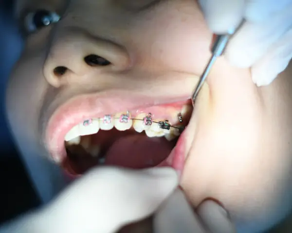 Dziecko z aparatem ortodontycznym, któremu dentysta czyści zęby. Irygator zamiast nici ułatwia higienę.