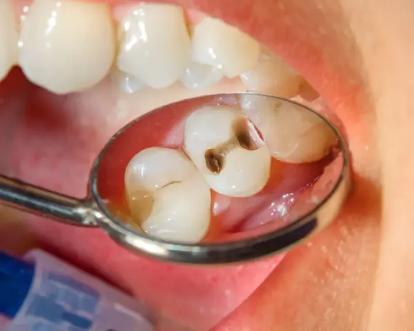 Zęby z próchnicą widziane w lusterku dentystycznym. Ksylitol, naturalny słodzik, może pomóc w zapobieganiu próchnicy.
