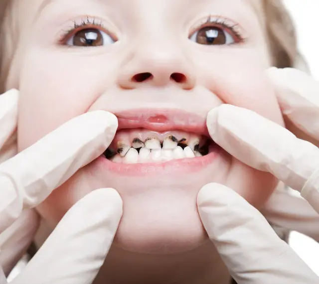 Dziecko z widoczną próchnicą zębów, badane przez dentystę w rękawiczkach.
