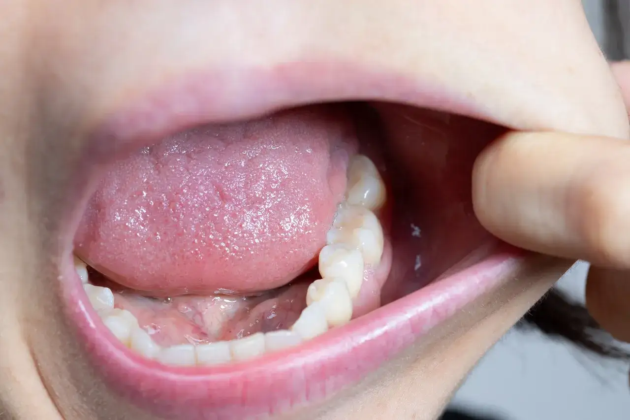 Otwarta jama ustna z językiem i zębami. Czy z afta można iść do dentysty? Tak, dentysta pomoże.