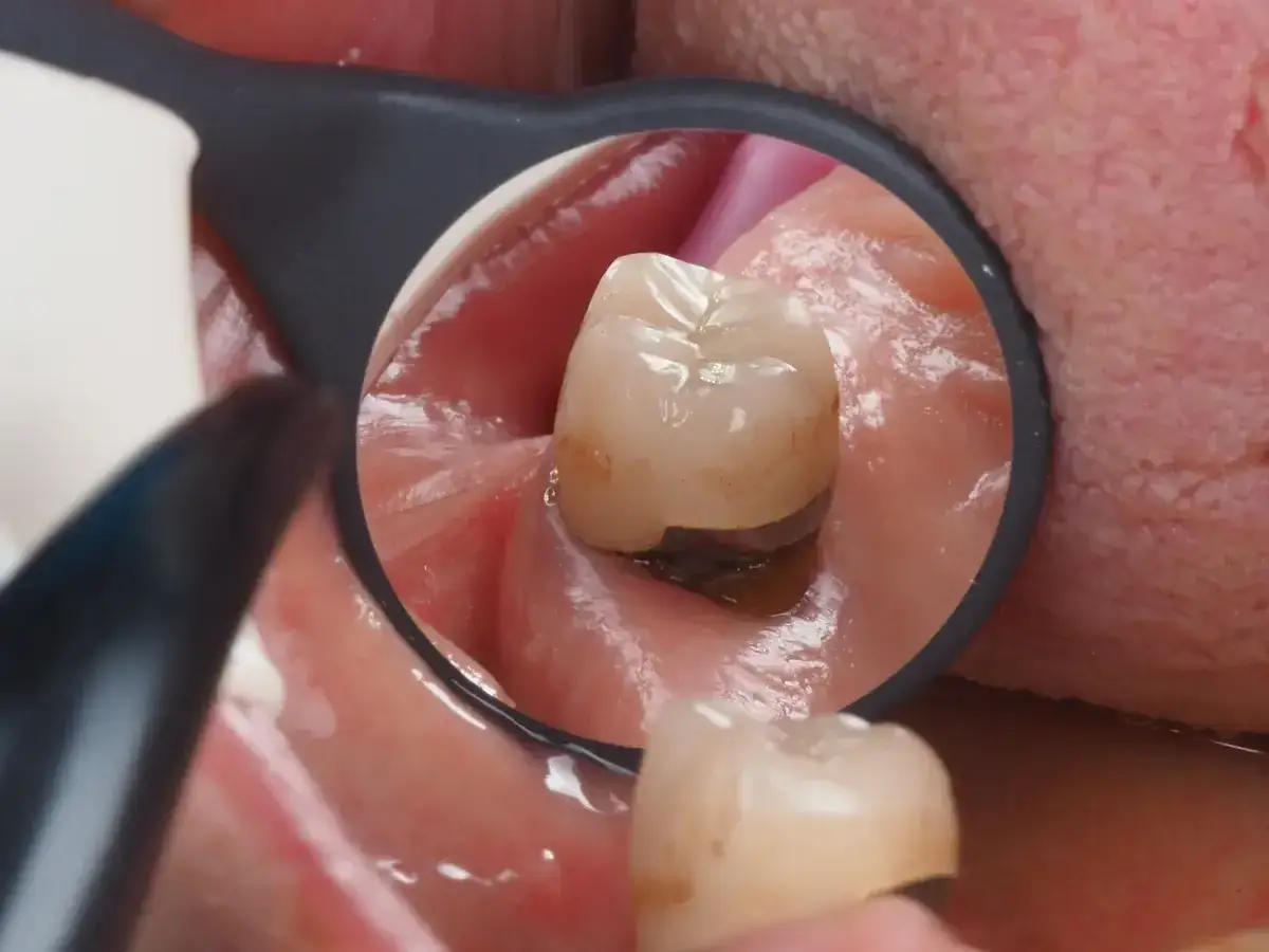 Widok z lusterka dentystycznego: stan zapalny dziąsła pod mostem, widoczny zaczerwieniony obszar wokół zęba.