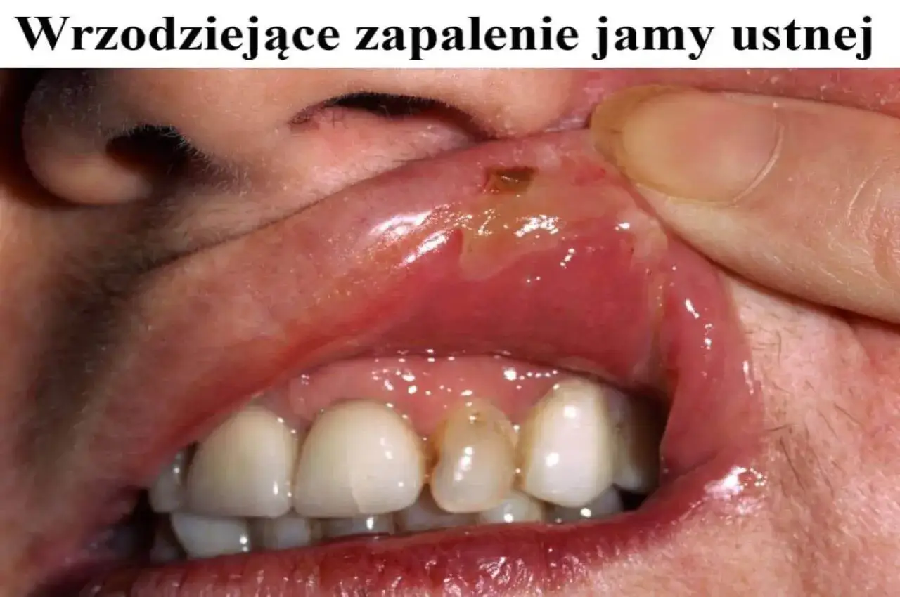 Widoczne owrzodziejące zapalenie jamy ustnej, z zaczerwienieniem i widocznymi ranami na błonie śluzowej.