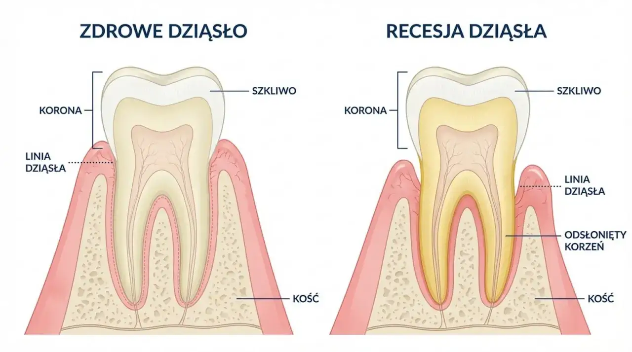 Zdrowe dziąsło vs. recesja dziąsła. Recesja odsłania korzeń, co może powodować dziwny ból między zębami.
