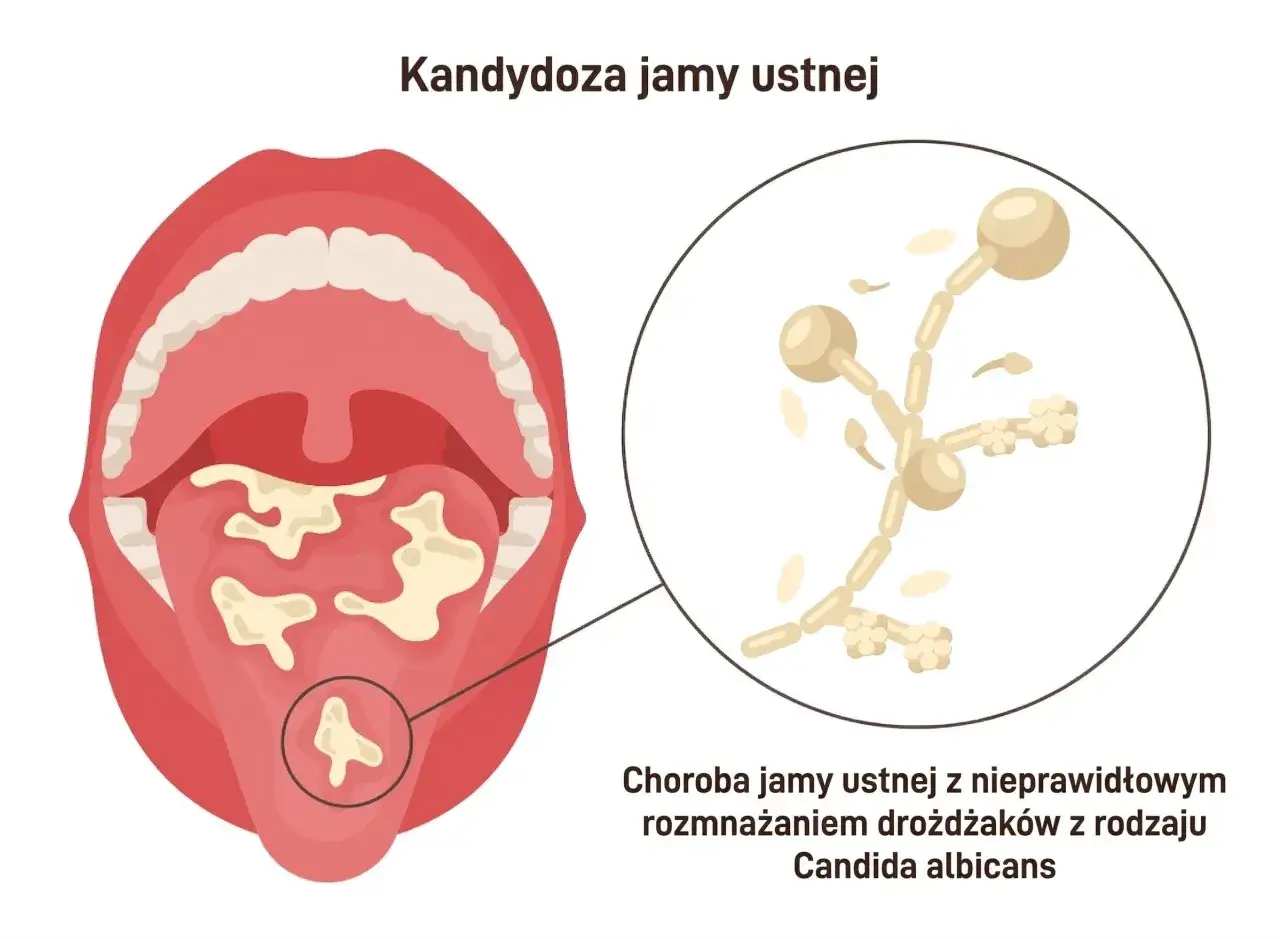 Grzybica jamy ustnej po antybiotyku: białe naloty na języku i podniebieniu, powiększenie drożdżaków Candida albicans.
