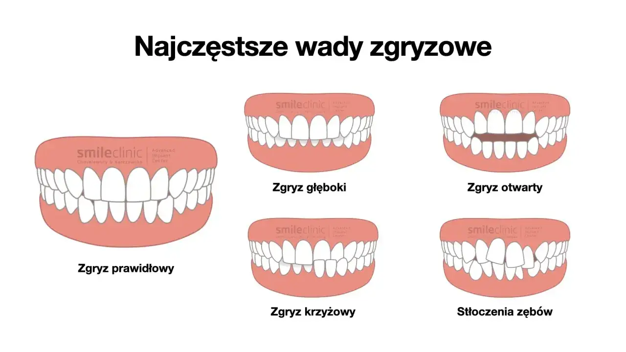 Ilustracja pokazuje różne wady zgryzu: prawidłowy, głęboki, otwarty, krzyżowy i stłoczenia zębów.