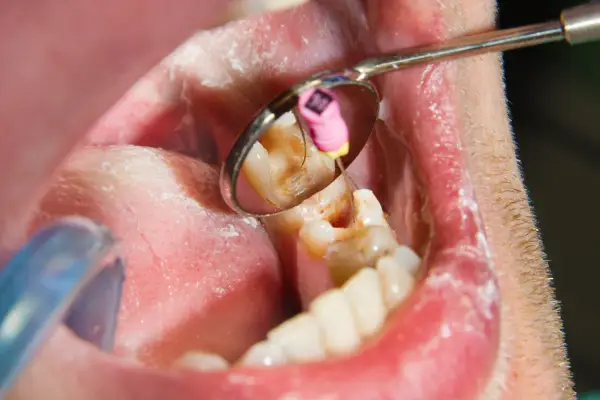Dentysta używa narzędzia do leczenia zęba, co na bolący ząb?