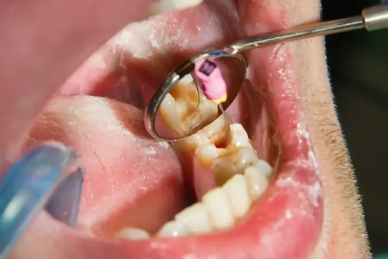 Dentysta wykonuje leczenie kanałowe martwego zęba, używając narzędzi widocznych w lusterku stomatologicznym.